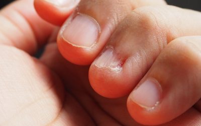 علت افتادن ناخن دست و پا کودکان چیست؟